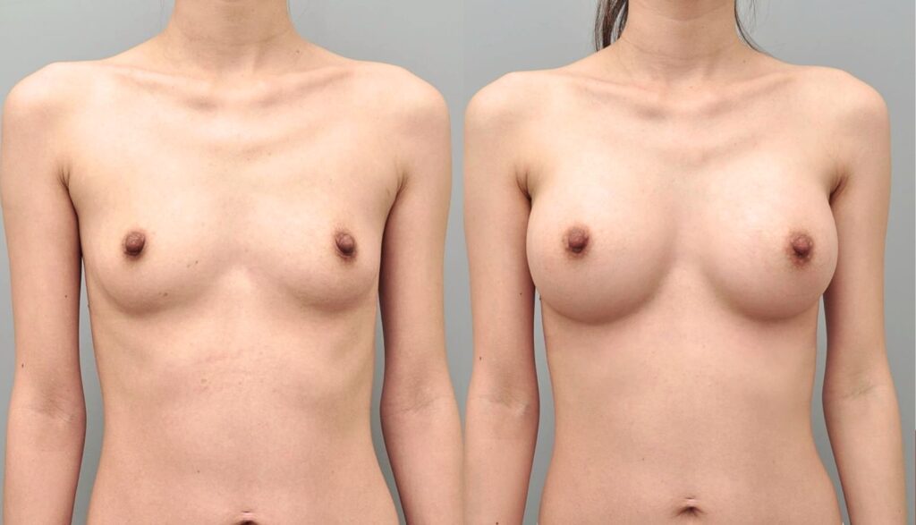 Underarm vs. Underbreast Incisions_ Differences in Korea