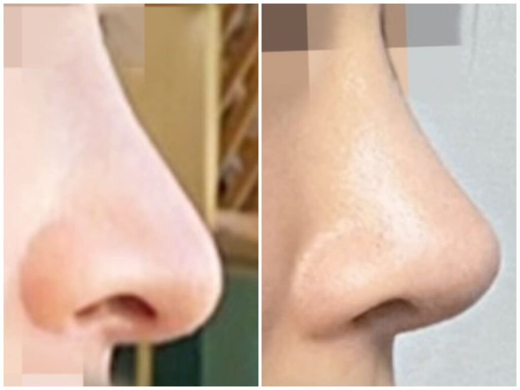 Understanding Revision Rhinoplasty in Korea