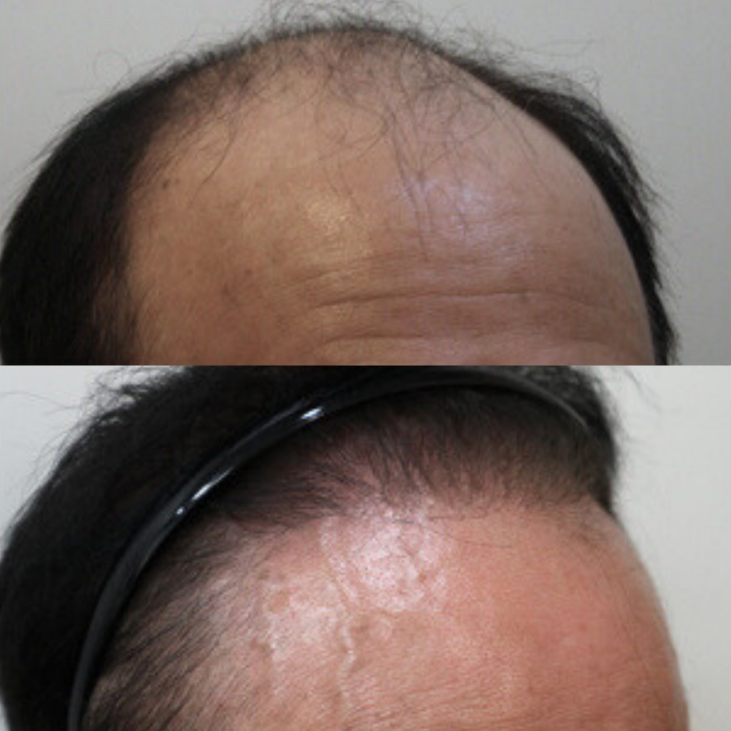 Unveiling the Success Rates of Hair Transplantation in Korea