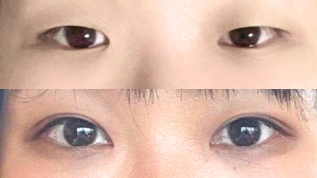 Upper Eyelid Lift_ Procedure Secrets in Korea