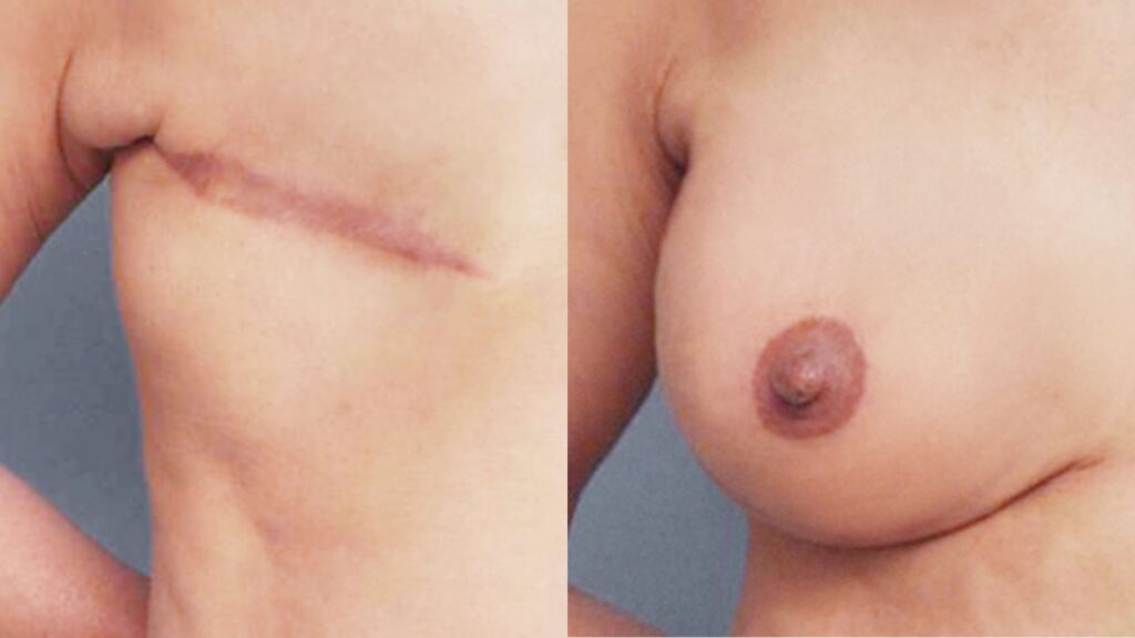 Using Implants for Breast Reconstruction in Korea