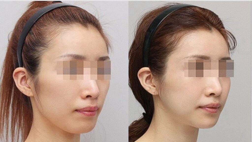 V-line Plastic Surgery for Facial Image Change in Korea