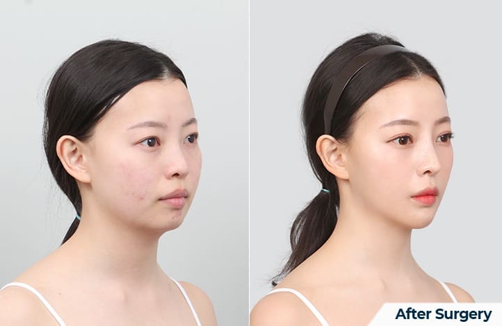 V-line Surgery Before and After in Korea