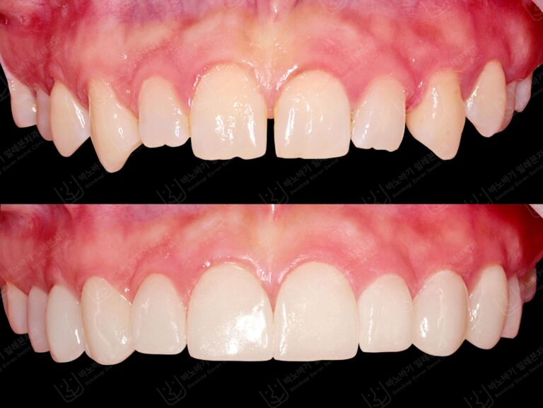 Veneers for a perfect smile in Korea