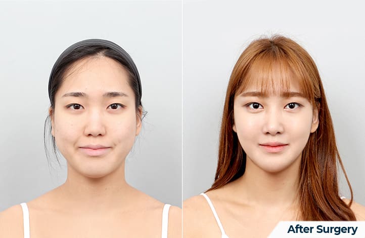 Visual Face Elongation Through Chin Correction in Korea