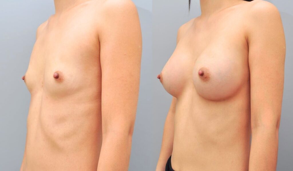 Visualizing Your Desired Breast Augmentation Outcome in Korea