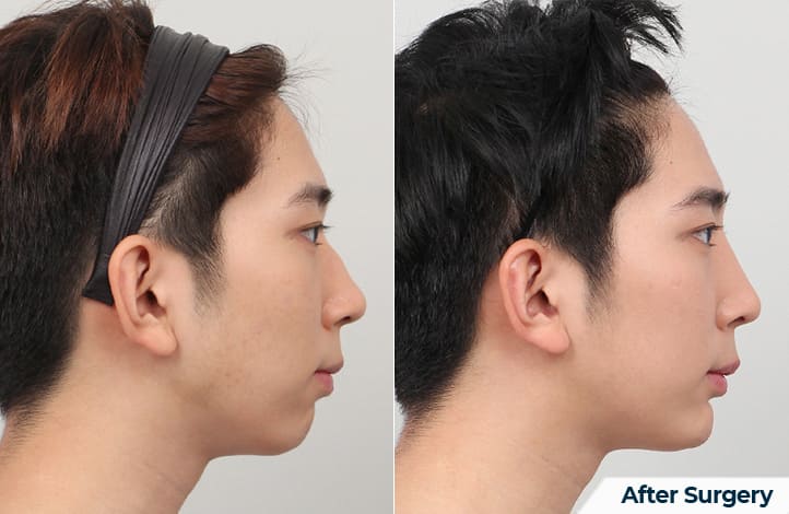 What Chin Augmentation Looks Like in Korea