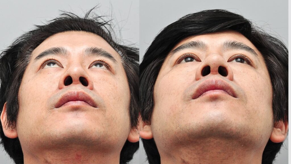 Who Can Perform Septoplasty_