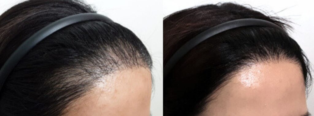 Woman after hair transplant in Korea