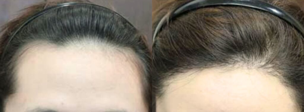 Woman happy again with hair transplant in Korea