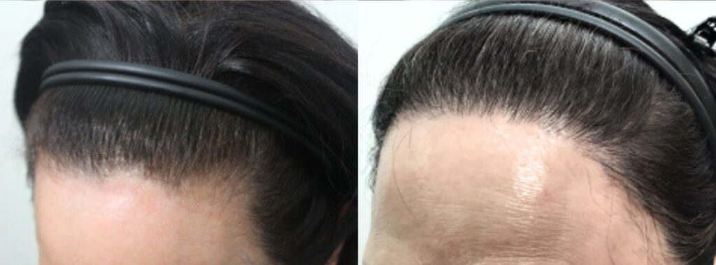 Woman_s confidence after hair transplant in Korea