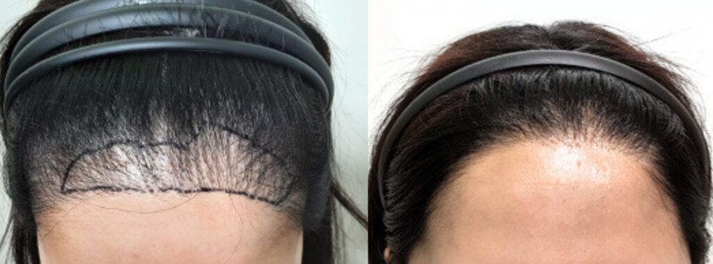 Women_s hair_ from loss to restoration in Korea