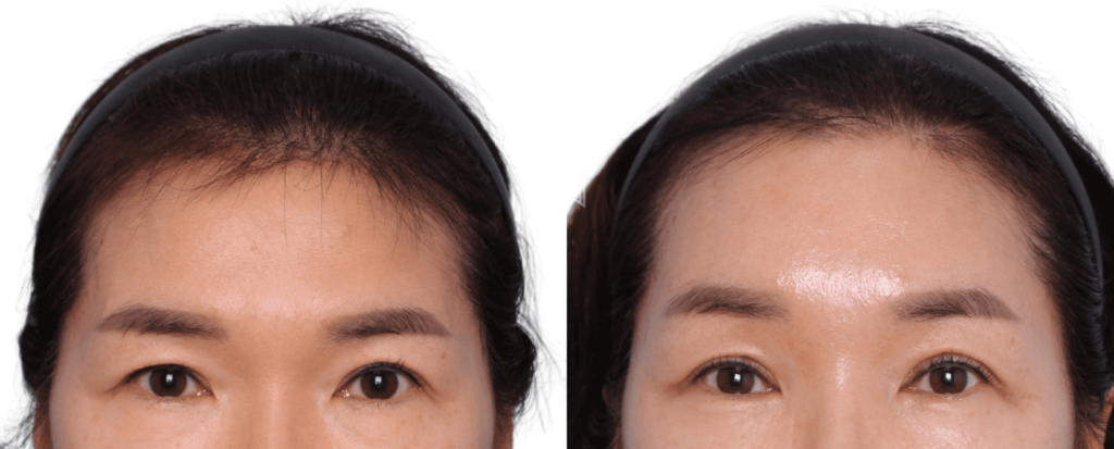 Wrinkle Correction with Forehead Lift in Korea